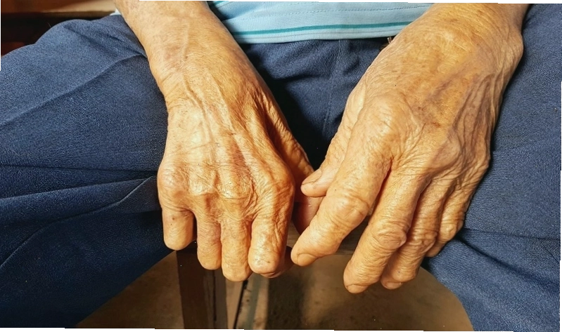 Bệnh phong không có tính di truyền mà gây ra bởi vi khuẩn Mycobacterium Leprae