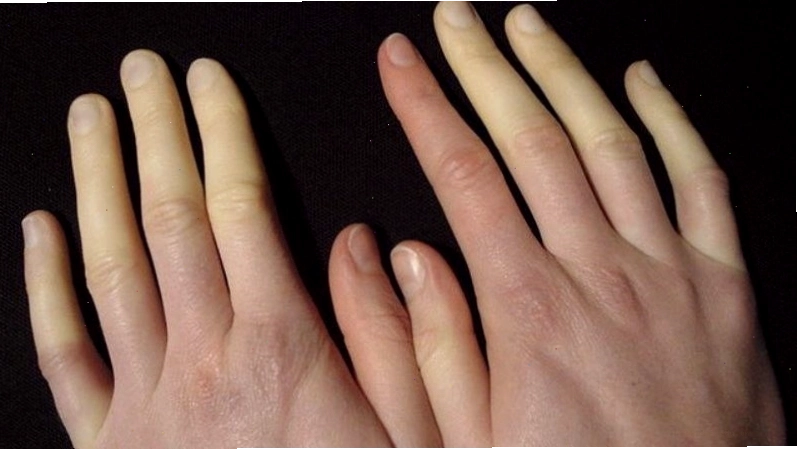 Bệnh Raynaud gây co thắt mạch máu dẫn đến tê đầu ngón tay