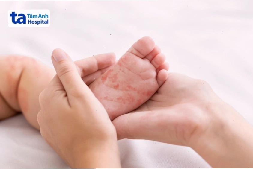 Bệnh sởi gây phát ban đỏ trên da