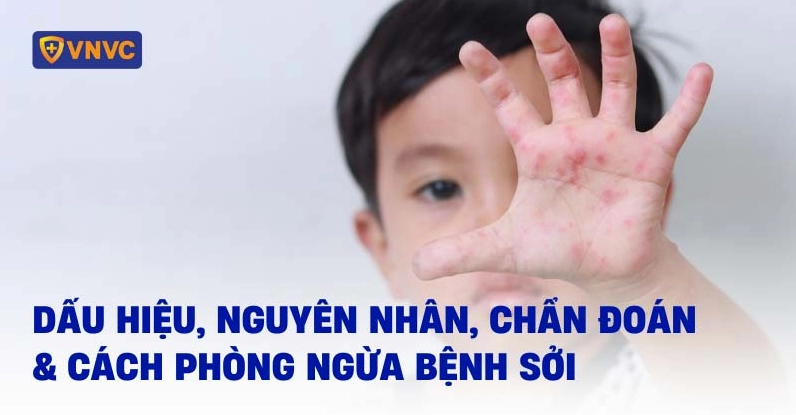 Bệnh sởi là bệnh gì? Nguyên nhân, dấu hiệu và cách phòng ngừa hiệu quả