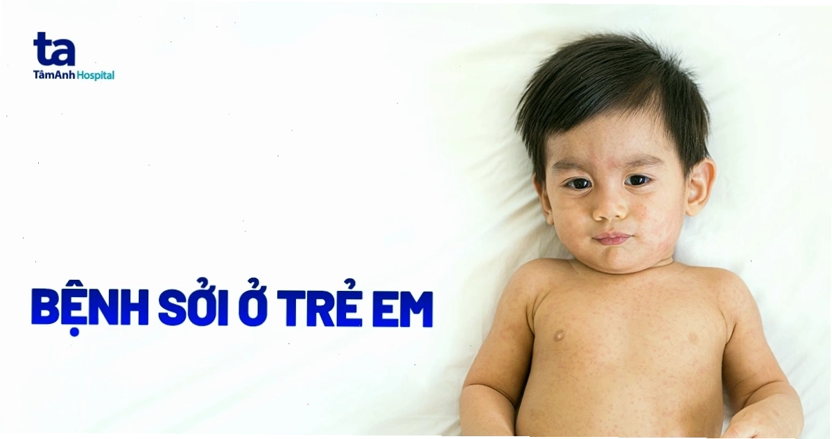 Bệnh sởi ở trẻ em và các biến chứng nguy hiểm