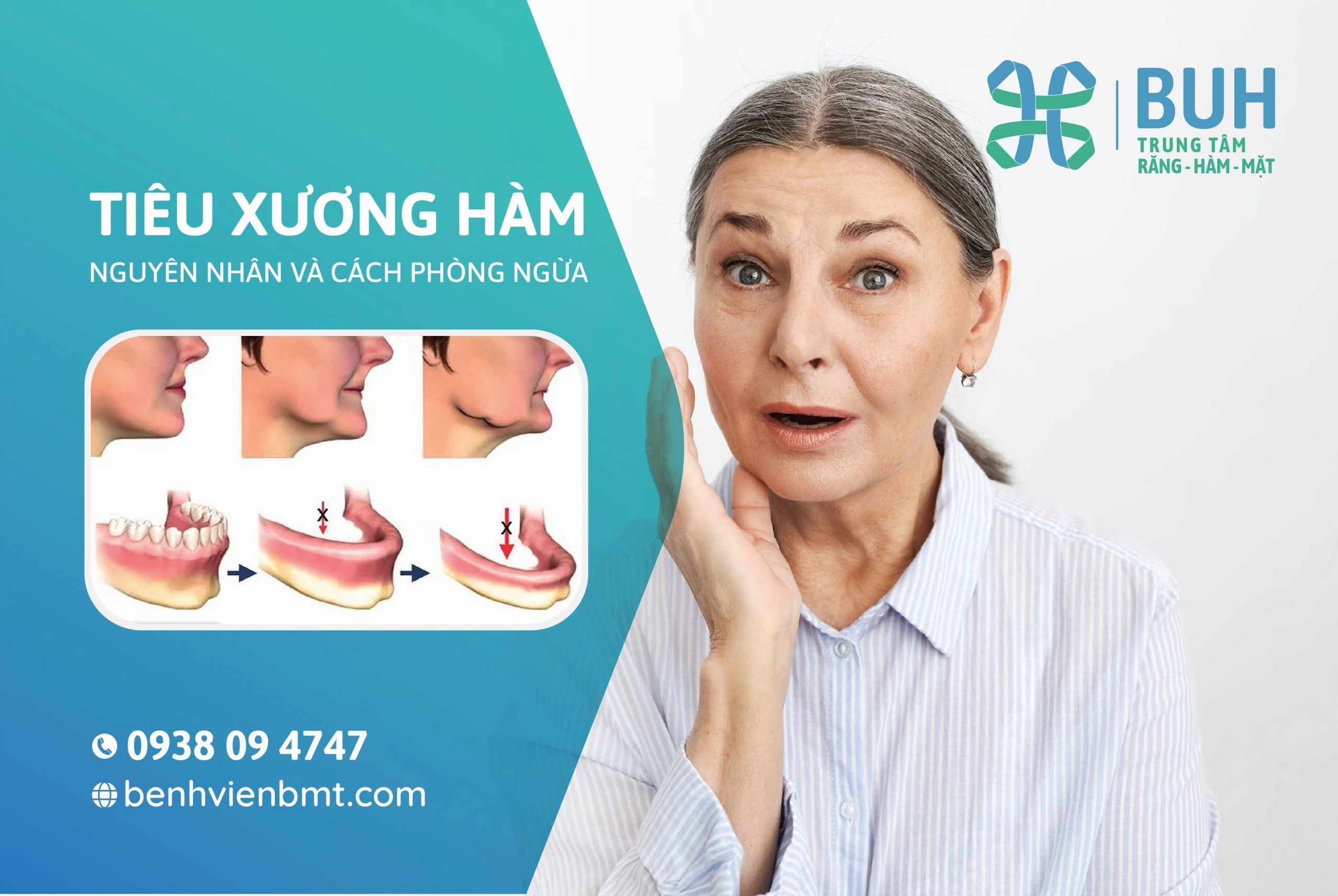 Bệnh Tiêu Xương Là Gì? Nguyên Nhân, Dấu Hiệu Và Cách Điều Trị Hiệu Quả
