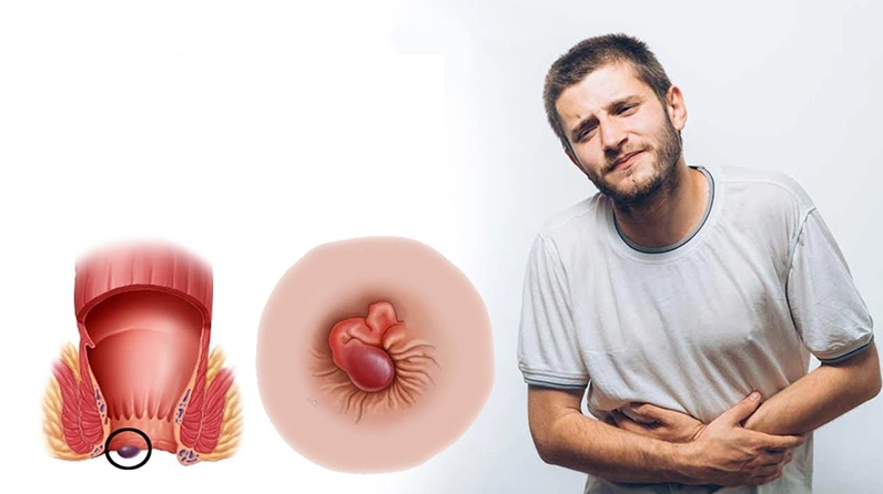 Bệnh trĩ dấu hiệu nhận biết sớm và các bước điều trị hiệu quả