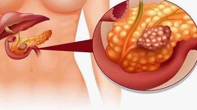 Bệnh tụy có nguy hiểm không? Những điều cần biết