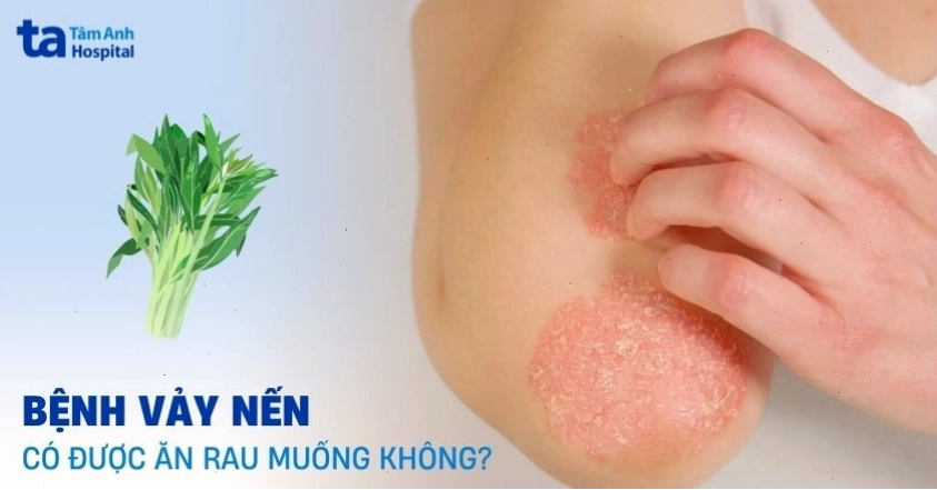 Bệnh vảy nến có thể cần kiêng một số thực phẩm như rau muống