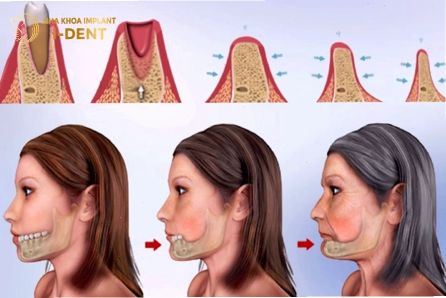 Biểu đồ cho thấy hậu quả của tình trạng tiêu xương răng
