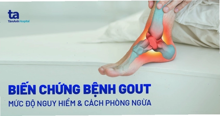 Các biến chứng nguy hiểm của bệnh gút