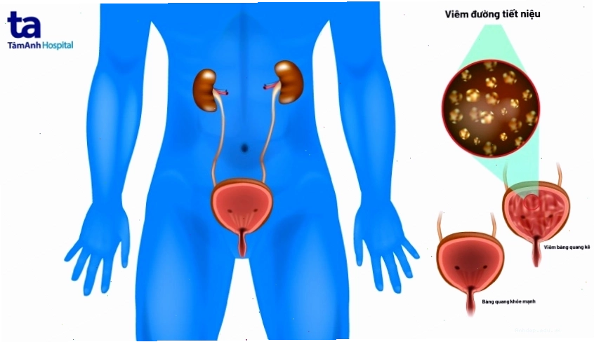 Các đối tượng có nguy cơ cao mắc bệnh về tuyến tiền liệt