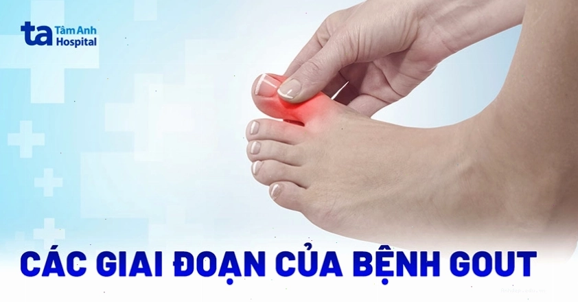 Các giai đoạn phát triển của bệnh gút