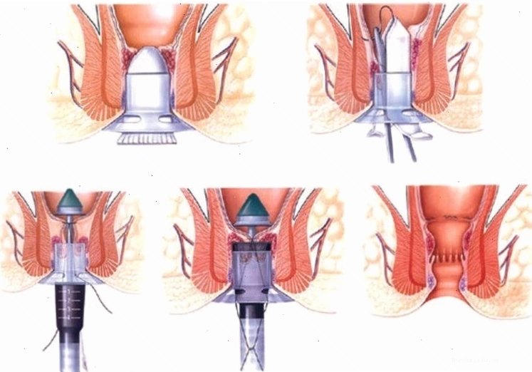 Các phương pháp điều trị bệnh trĩ phổ biến