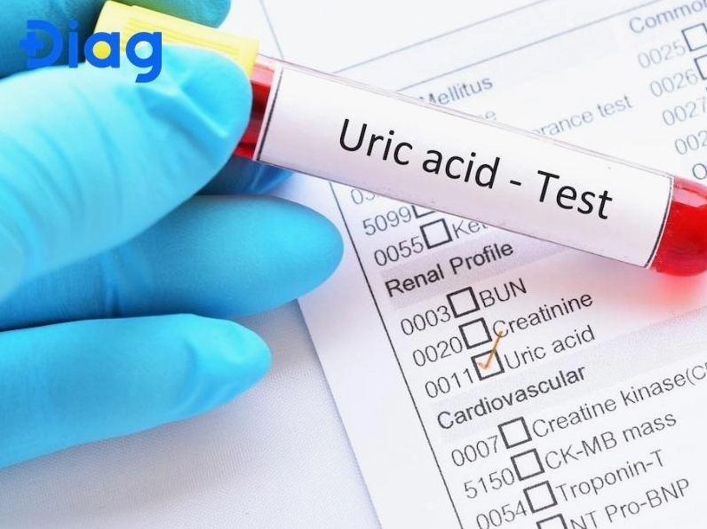 Cách nhận biết bệnh gút: Dấu hiệu và triệu chứng cần biết năm 2026
