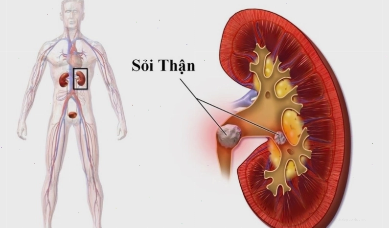 Cây cỏ xước có công dụng hỗ trợ điều trị bệnh sỏi thận