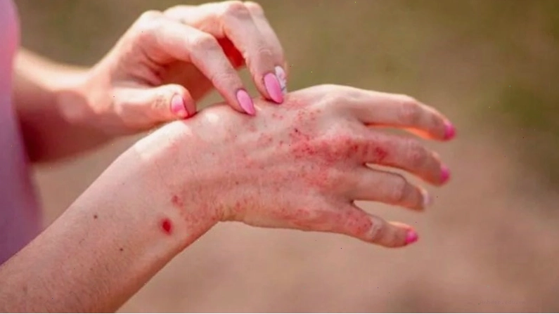 Cây sầu đâu có công dụng giúp giảm các tình trạng dị ứng da hiệu quả