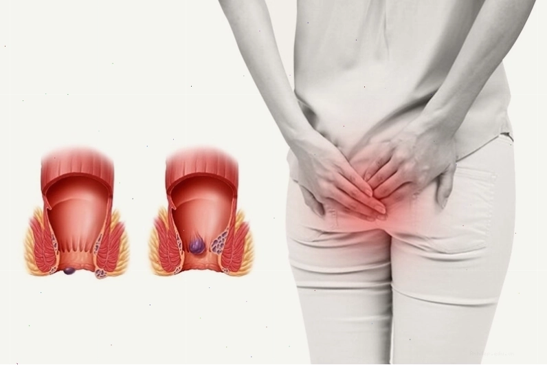 Giữ gìn vệ sinh cá nhân là một phần quan trọng trong việc điều trị bệnh trĩ