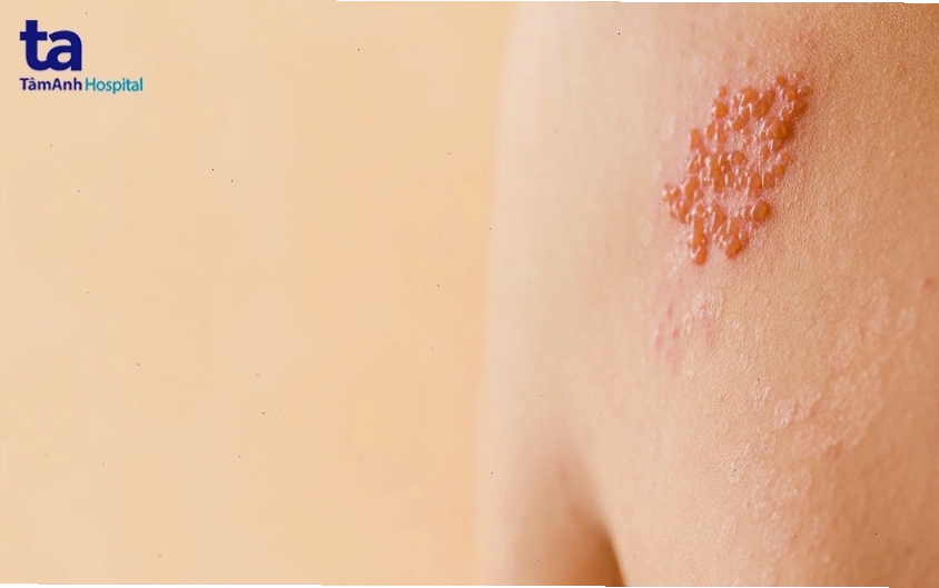 Herpes sinh dục