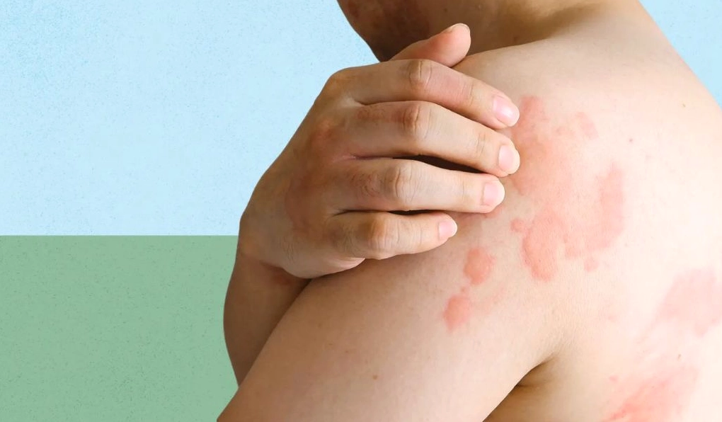 Hình ảnh bệnh phong ngứa và những điều cần biết