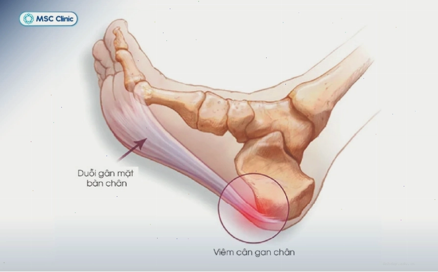 Hình ảnh minh họa các hoạt động thể chất phù hợp để phòng ngừa đau gót chân
