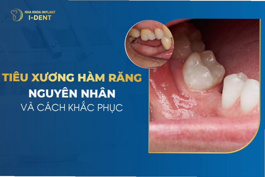 Hình ảnh minh họa các nguyên nhân gây tiêu xương hàm