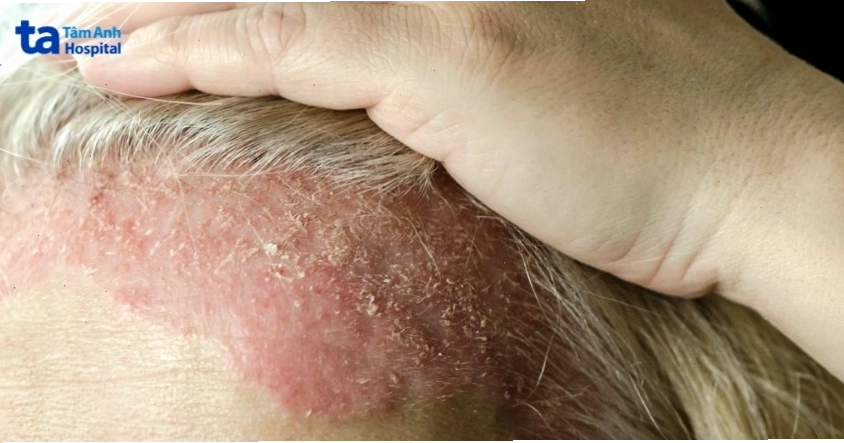 Hình ảnh vảy nến xuất hiện trên da đầu người bệnh