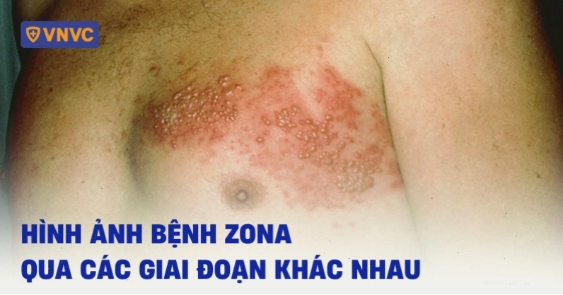 Hình ảnh virus zona Varicella-Zoster
