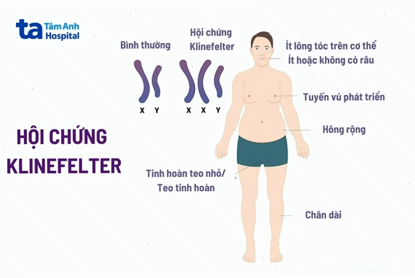 Hội chứng Klinefelter là nguyên nhân phổ biến gây vô sinh nam