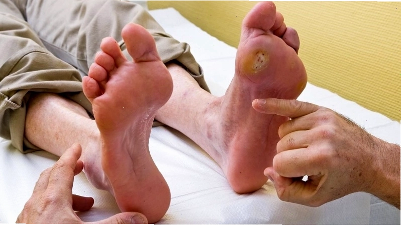 Lở loét và nhiễm trùng cơ thể do biến chứng của bệnh phong