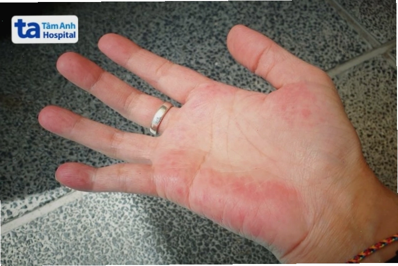 Lupus ban đỏ hệ thống (SLE) là một nguyên nhân gây suy giảm miễn dịch