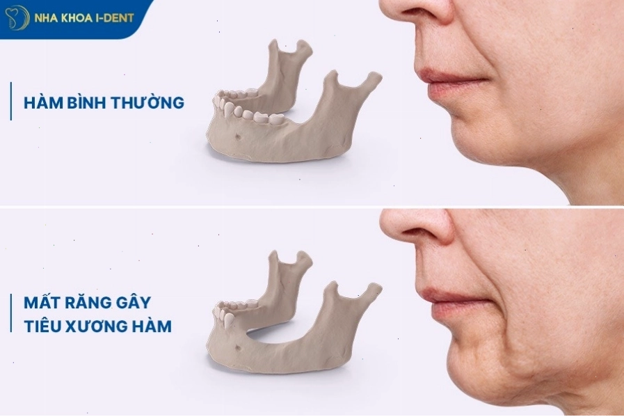 Minh họa các biện pháp phòng ngừa tiêu xương răng