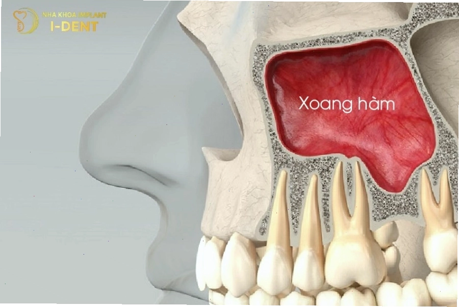 Minh họa kỹ thuật nâng xoang hàm trên