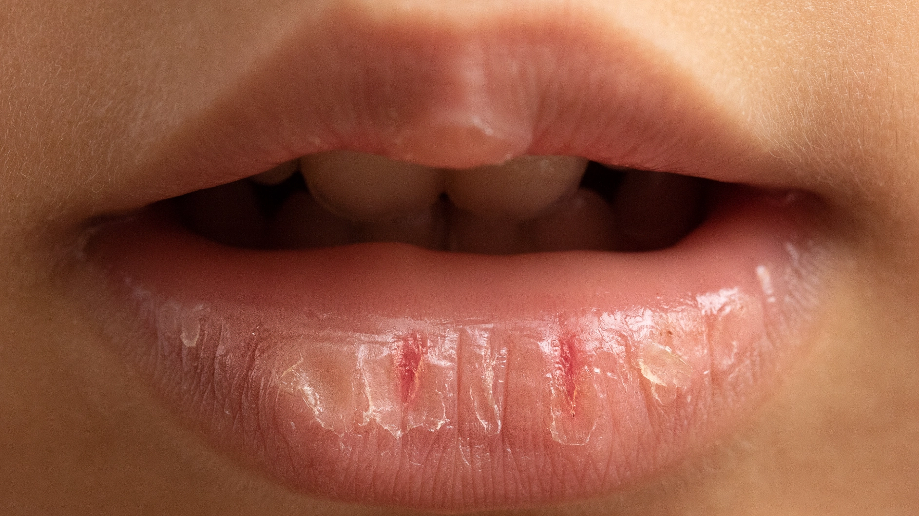 Ngủ Dậy Khô Miệng Là Dấu Hiệu Của Bệnh Gì và Cách Khắc Phục