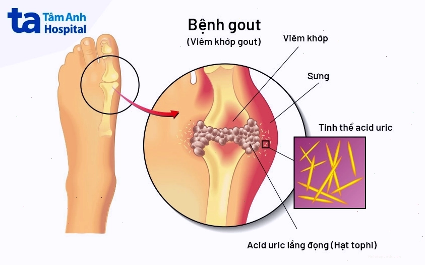 Người bệnh gút trải qua những cơn đau khớp dữ dội