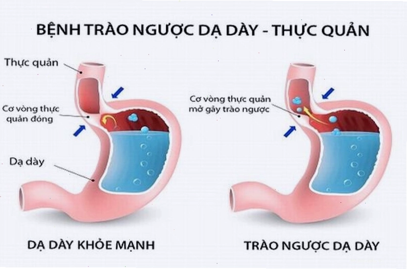 Người mắc bệnh trào ngược dạ dày thực quản có thể cảm thấy khô miệng khi ngủ dậy