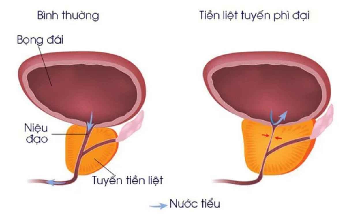Nguyên nhân bệnh tiền liệt tuyến: Hiểu rõ để phòng tránh hiệu quả