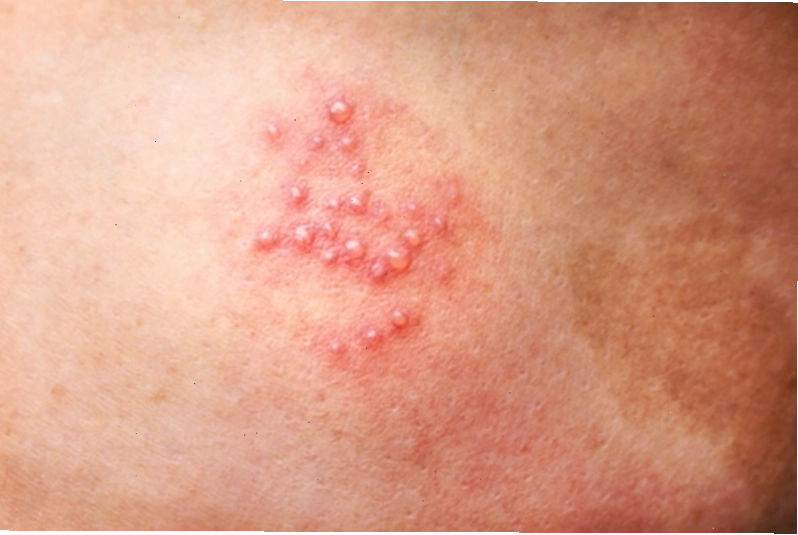 Những mụn nước trên vùng da bị bệnh zona