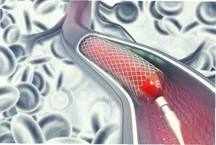 Nong và đặt stent động mạch vành