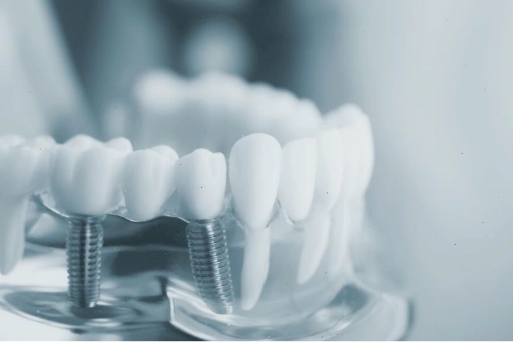Phương pháp cấy ghép răng Implant sau khi ghép xương