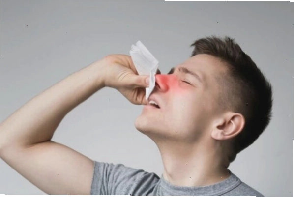Polyp mũi có thể gây chảy máu cam hoặc nước mũi màu nâu