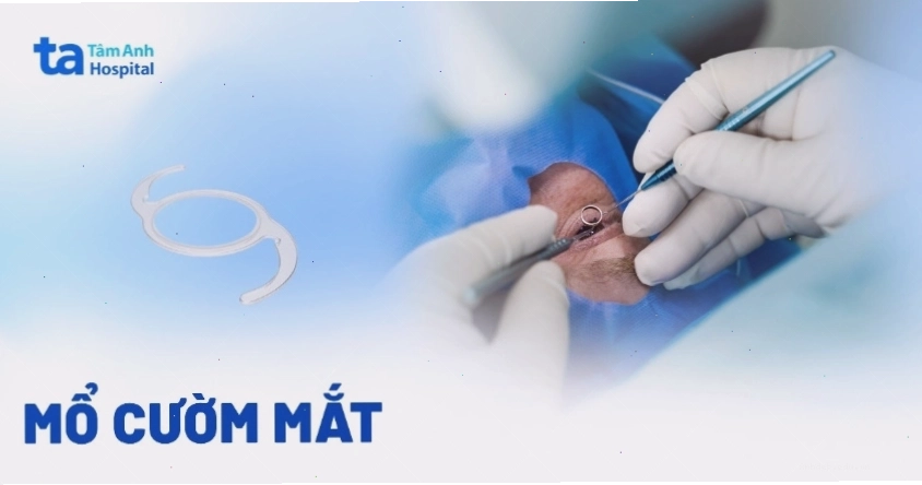 Quy trình phẫu thuật cườm mắt bằng phương pháp Phaco