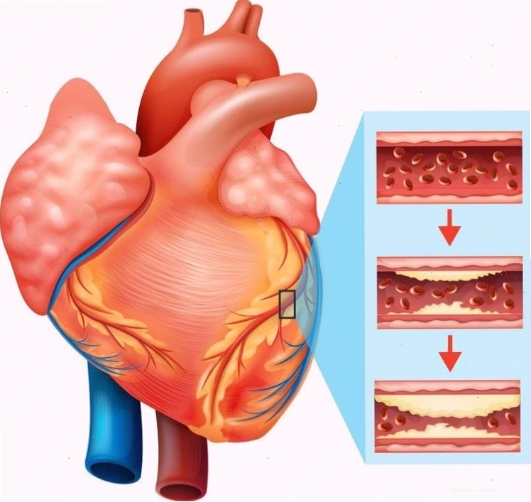 Sự tích tụ mảng bám trong lòng động mạch là nguyên nhân chính gây bệnh mạch vành