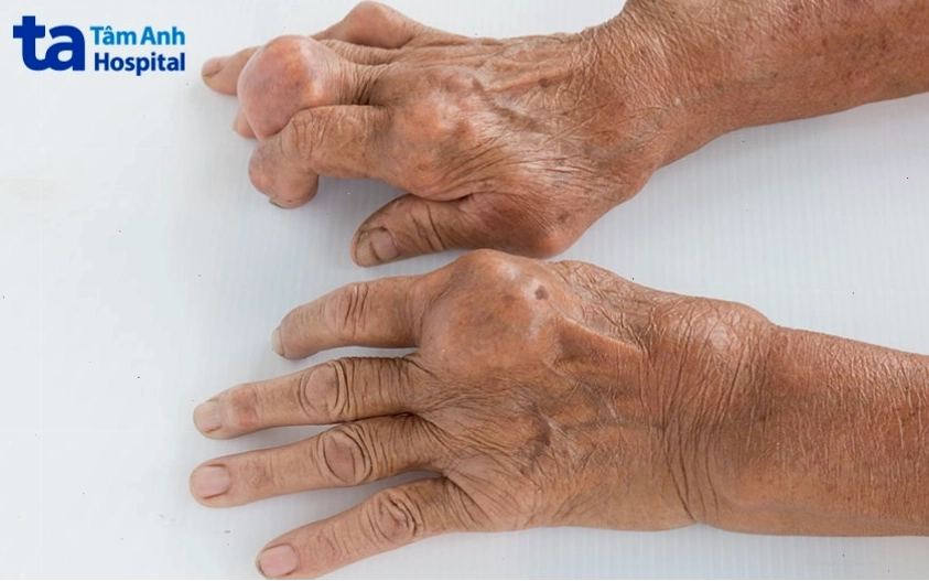 Sự xuất hiện của các nốt tophi dưới da ở người bệnh gút
