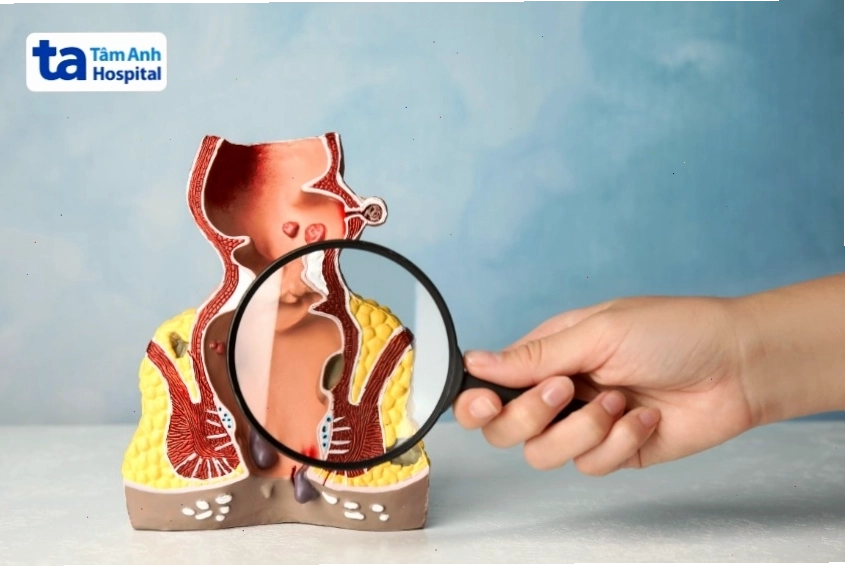 Tình trạng rò hậu môn trực tràng