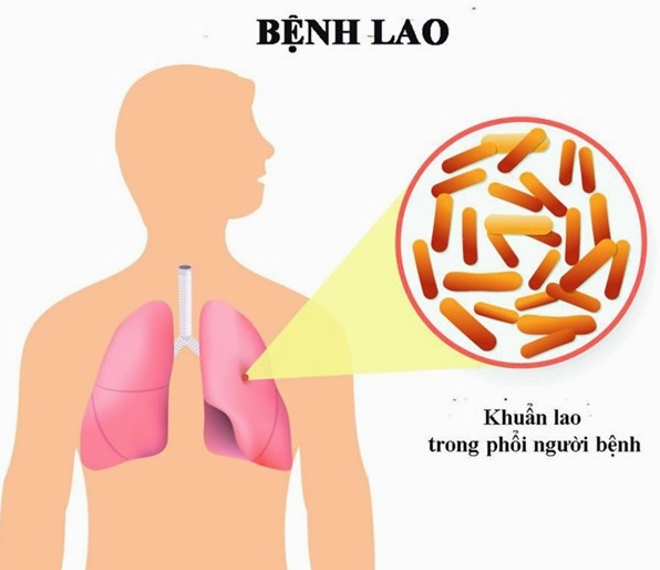 Triệu chứng bệnh lao phổi: Nhận biết sớm để điều trị kịp thời