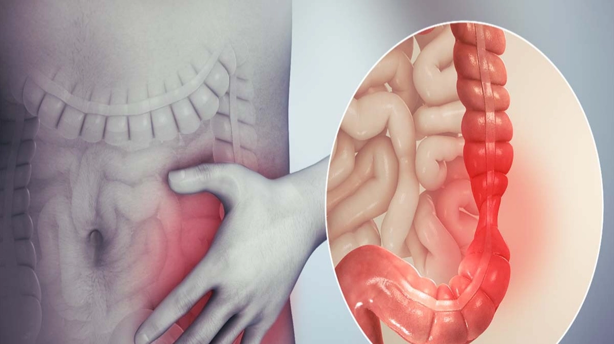 Triệu chứng nhận biết viêm đại tràng và cách khắc phục hiệu quả