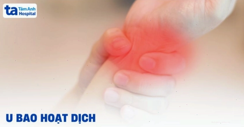 U bao hoạt dịch ở khớp