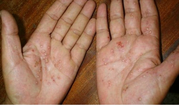 Vảy nến thể mủ xuất hiện ở lòng bàn tay