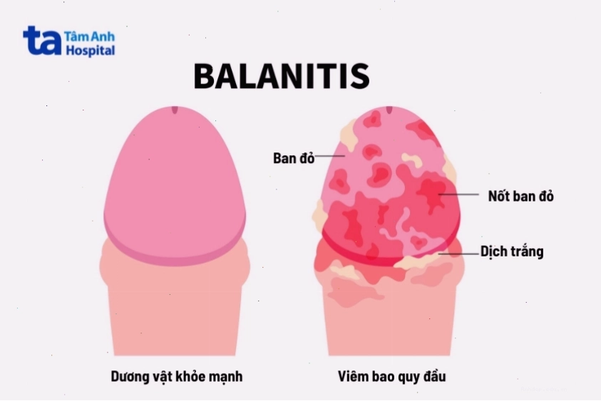 Viêm bao quy đầu nặng có thể gây lở loét và mưng mủ