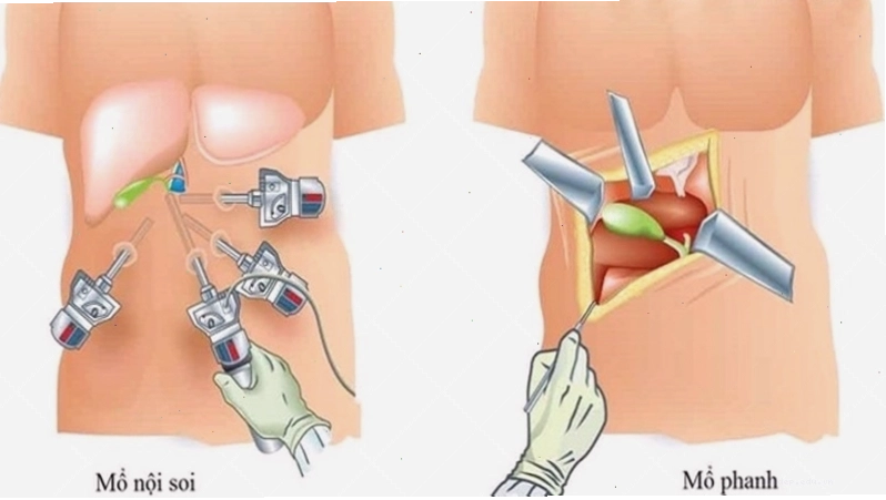 Viêm loét đại tràng gây tiêu chảy kéo dài