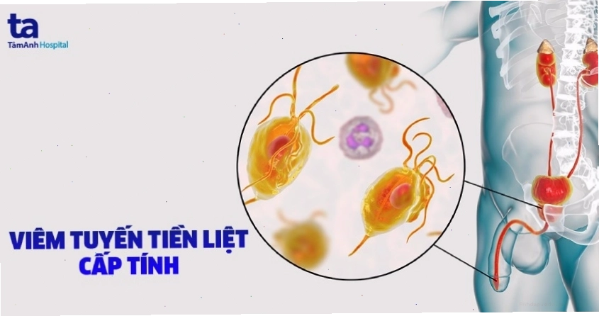 Viêm tuyến tiền liệt cấp tính với các triệu chứng điển hình