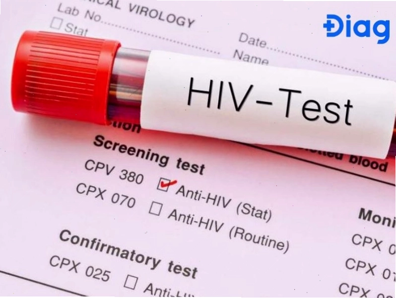 Xét nghiệm HIV là cách duy nhất để chẩn đoán chính xác