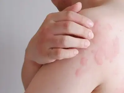 101+ Hình ảnh nhận biết bệnh nổi mề đay qua các giai đoạn